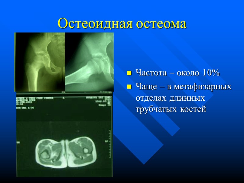 Остеоидная остеома Частота – около 10% Чаще – в метафизарных отделах длинных трубчатых костей